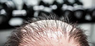 Creatina Causa Queda de Cabelo? A Verdade Revelada + Como Evitar